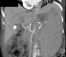 Cirrhosis - CTisus CT Scan