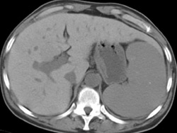 Hepatoma in Patient With Glycogen Storage Disease - CTisus CT Scan