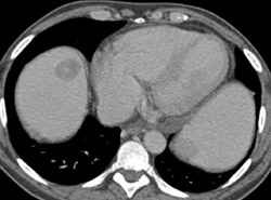 Hepatoma - CTisus CT Scan