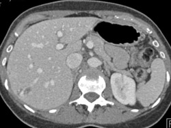 Hemangioma - CTisus CT Scan