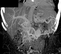 Occlusion of Portal Vein/Superior Mesenteric Vein (SMV) Confluence With Collaterals - CTisus CT Scan