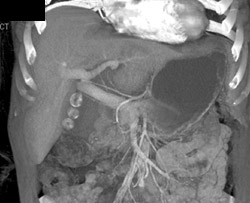 Hemangioma - CTisus CT Scan