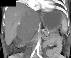 Giant Hemangioma - CTisus CT Scan