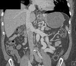 Retroperitoneal Varices Due to Cirrhosis - CTisus CT Scan