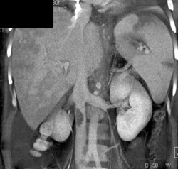 Patchy Enhancement Liver With Clot in IVC and Splenic Infarcts - CTisus CT Scan