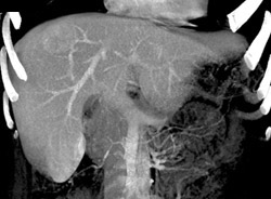 Subtle Focal Nodular Hyperplasia (FNH) - CTisus CT Scan