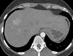 Focal Nodular Hyperplasia (fnh) - CTisus CT Scan