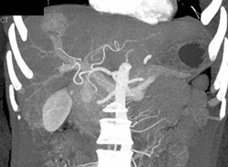 Focal Nodular Hyperplasia (FNH) - CTisus CT Scan