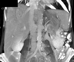 Liver Abscesses - CTisus CT Scan