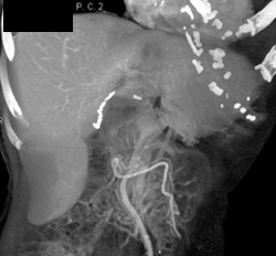 Normal Hepatic Venous Anatomy - CTisus CT Scan