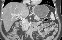 Collaterals in Porta and Near Pancreas - CTisus CT Scan