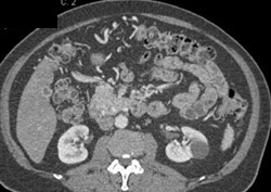 Cirrhosis With Cavernous Transformation of the Portal Vein (CTPV) - CTisus CT Scan