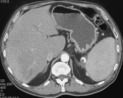 Cirrhosis With Patchy Enhancement - See Next Image - CTisus CT Scan