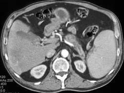 Cavernous Transformation of the Portal Vein - CTisus CT Scan