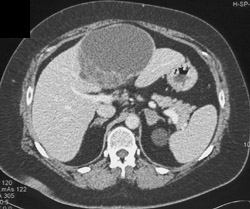 Biliary Cystadenocarcinoma - CTisus CT Scan