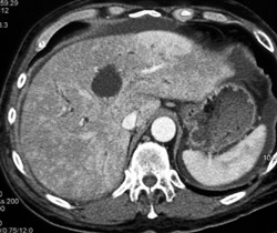 Patchy Enhancement Liver - CTisus CT Scan