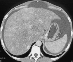 Regenerating Nodes in Liver - CTisus CT Scan