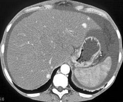 Regenerating Nodules - CTisus CT Scan