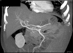 Replaced Right Hepatic Aa of the SMA - CTisus CT Scan