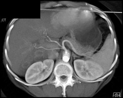 Variant in Hepatic Artery Anatomy - CTisus CT Scan