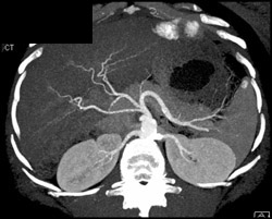 Right Hepatic Artery Directly Off the Aorta - CTisus CT Scan