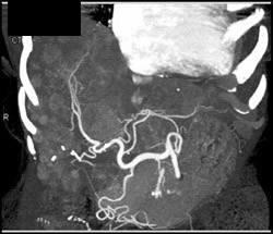 Carcinoid Tumor Metastatic to the Liver - CTisus CT Scan