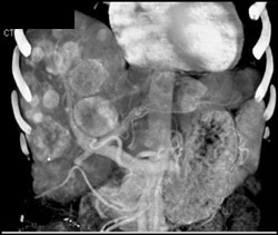 Metastatic Carcinoid Tumor - CTisus CT Scan