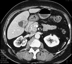 Gallbladder Cancer - CTisus CT Scan