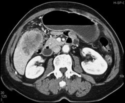 Gallbladder Cancer - CTisus CT Scan