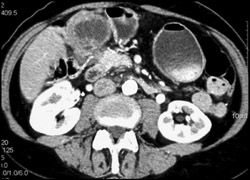 Gallbladder Cancer - CTisus CT Scan