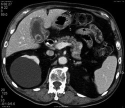 Acute Cholecystitis and Gallbladder Cancer - CTisus CT Scan