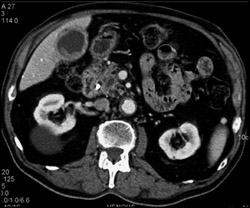 Gallbladder Cancer - CTisus CT Scan