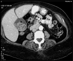 Gallstones With Sludge - CTisus CT Scan