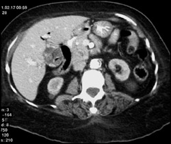 Gallstones With Mercedes Benz Stone - CTisus CT Scan