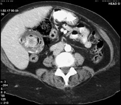 Acute and Chronic Cholecystitis - CTisus CT Scan