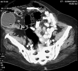 Fistulae From Gallbladder to Bowel - CTisus CT Scan