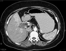 Focal Enhancement Liver Near Inflamed Gallbladder - CTisus CT Scan