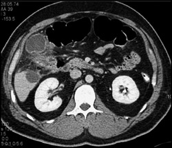 Acute Cholecystitis - CTisus CT Scan