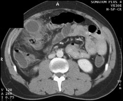 Acute Cholecystitis - CTisus CT Scan