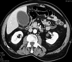 Acute Cholecystitis - CTisus CT Scan