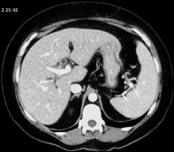 Cbo Obstructed By Passed Stone - CTisus CT Scan