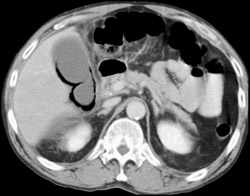 Eplemphysematous Cholecystitis - CTisus CT Scan