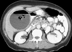 Gallbladder Abscess - CTisus CT Scan