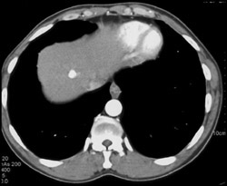 Metastatic Carcinoid Tumor - CTisus CT Scan