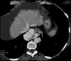 Esophageal Varices - CTisus CT Scan