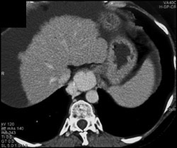 Esophageal Varices - CTisus CT Scan