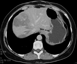 Fatty Liver - CTisus CT Scan