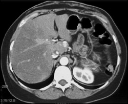 Focal Fatty Infiltration - CTisus CT Scan