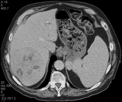 Hepatoma - CTisus CT Scan