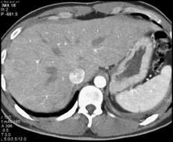 Normal Hepatic Veins - CTisus CT Scan